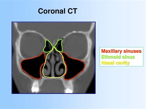 Ppt Anatomy And Relevant Anatomical Variants In Nasal And Paranasal