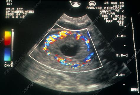 Doppler Ultrasound Of Corpus Luteum In The Ovary Stock Image P616