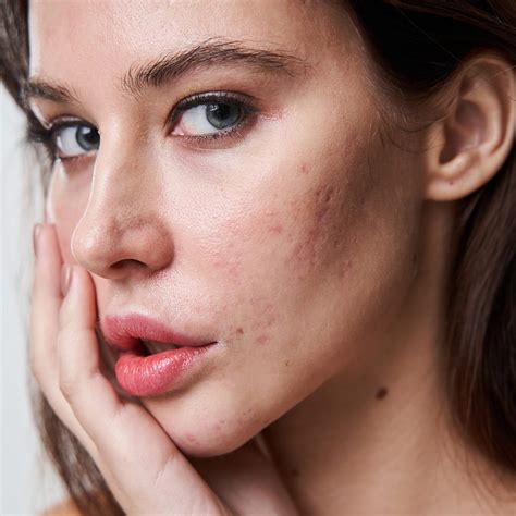 Acne Scarring Causes And Effective Treatments At Le Parlour Nyc