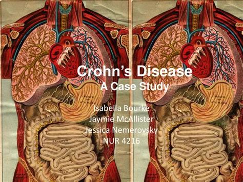 Ppt Crohns Disease A Case Study Powerpoint Presentation Free