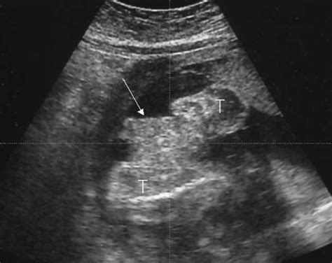New Sonographic Finding For The Prenatal Diagnosis Of Bladder Exstrophy