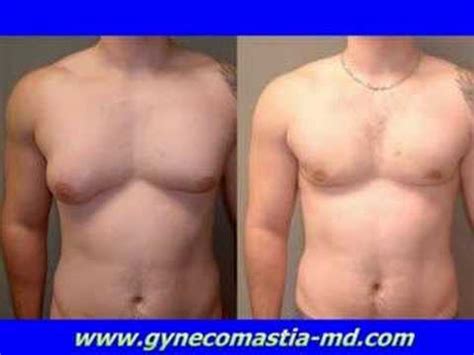 Male breast reduction or gynecomastia surgery costs may differ between practices, and in some instances, even vary between two patients at the same practice. Dr Blau - Gynecomastia Surgery cost- Severe - Male Breast ...