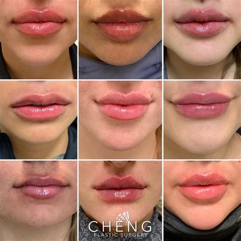 Cheng Plastic Surgery And Medspa On Instagram Lip Inspo ⁣ ⁣ Here Is