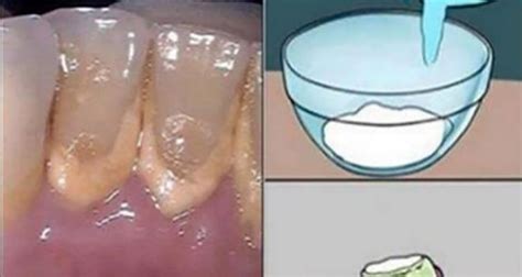 Here are 6 natural ways to clean tartar and plaque off your teeth. Be Your Own Dentist and Learn How To Clean Tartar on Teeth