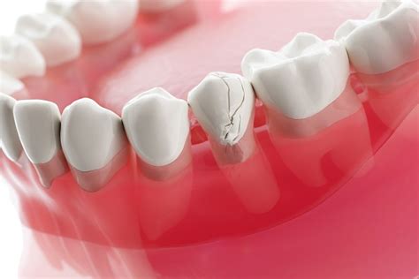Get A Broken Tooth Treated To Avoid Complications Trophy Smile Studio