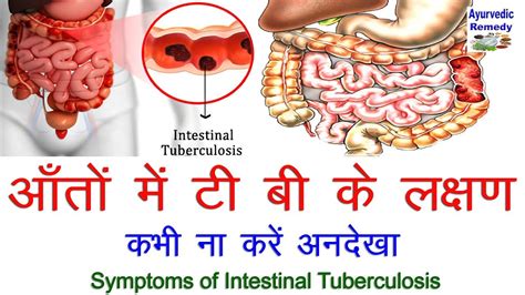 आंतों की टी बी के लक्षण Tb Symptoms Intestinal Tuberculosis