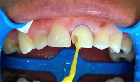 Lo Que Debes Saber Acerca De La Caries Dental Odonton
