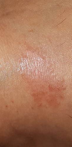 Как убрать целлюлит на внутренней стороне бедра