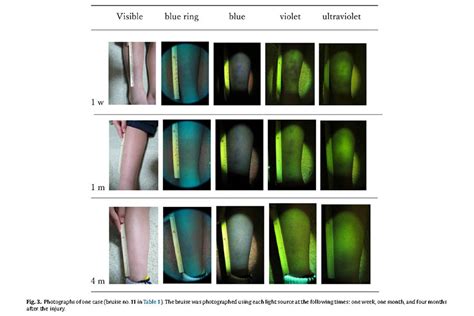 Visualization Of Old Bruises In Children Godoy Medical Forensics