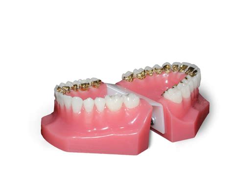 Lingual Braces Hidden Braces Manchester Orthodontics