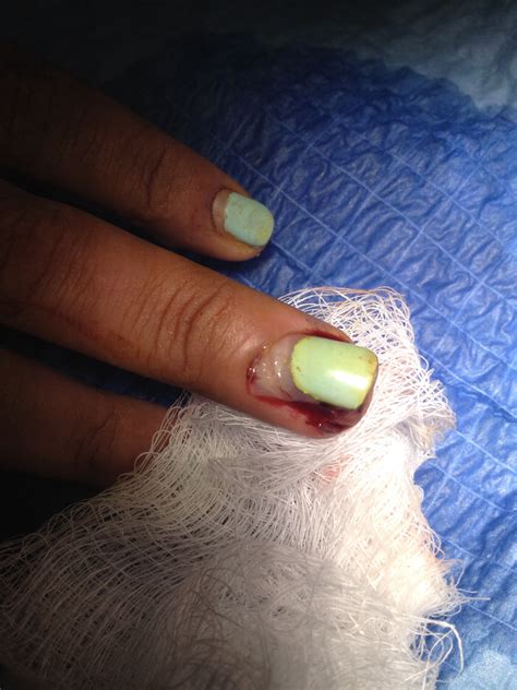 In Patients With Partial Nail Avulsion With Preserved Nail Structure