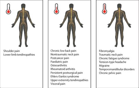 Central Sensitisation In Chronic Pain Conditions Latest Discoveries