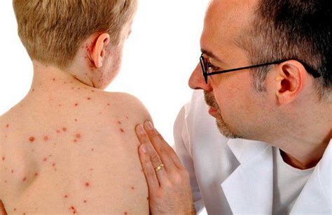 Measles Symptoms And Causes Medikoe