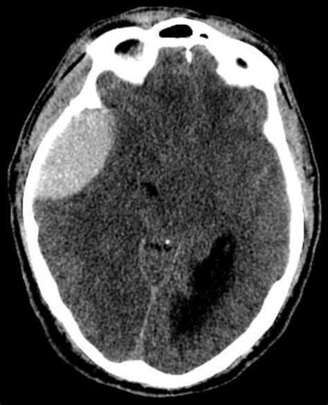 Intracranial Hemorrhage - Traumatic - Undergraduate ...