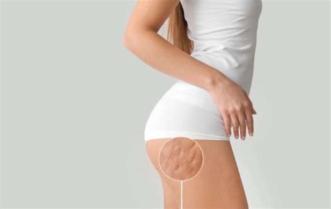 Proven Causes Of Butt Dents And Their Treatments