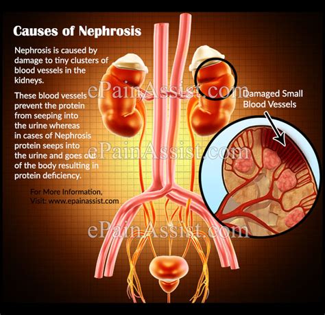 What Causes Nephrosis And How Is It Treated