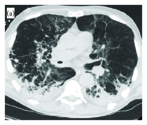 A Computed Tomography Thorax Revealed Severe Bullous Emphysema And