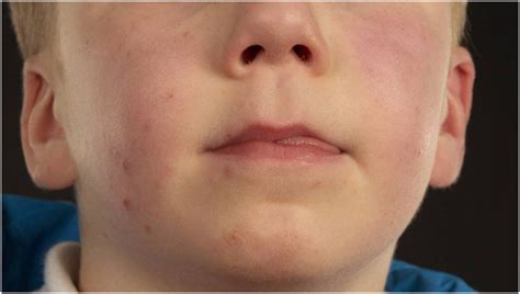 Childhood Acne In A Boy With Xyy Syndrome Bmj Case Reports