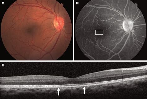 Clinical Imaging Of The Right Eye A Color Fundus Photograph Shows No