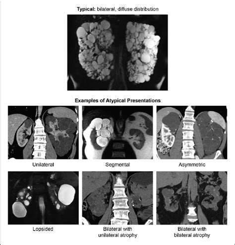 Mayo Clinic Classification Of Autosomal Dominant Polycystic Kidney