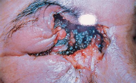 Massive Orbital Myiasis Infestation | Dermatology | JAMA Ophthalmology