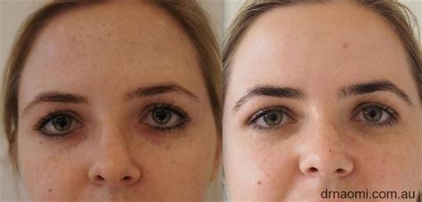 Freckle Removal Face Faqs Best Clinic Sydney For Dermal Fillers