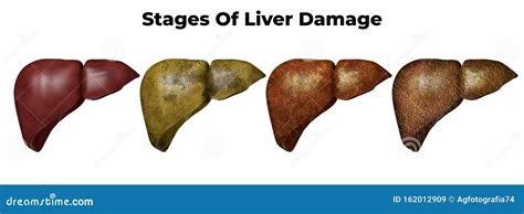 Stages Of Liver Damage The First Symptoms Of Liver Problems Are