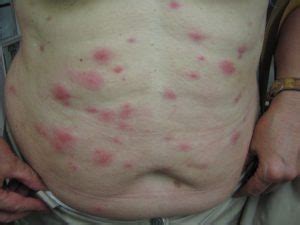 Two types of mites that can be spread between dogs and humans are known as sarcoptic mites and demodectic mites. INDOOR ENTOMODERMATOSES: TYPICAL LESIONS - Perprin S.r.l ...