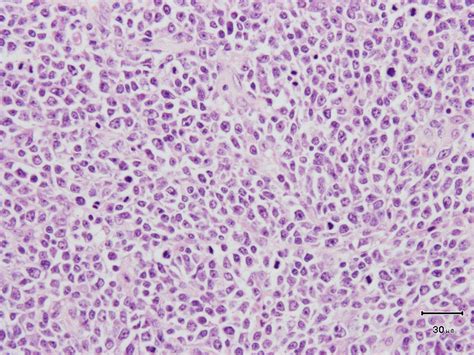 Full Text Diffuse Large B Cell Lymphoma Of Tonsil And Testis