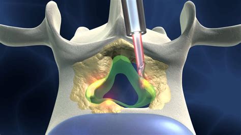 Full Endoscopic Spinal Surgery For Spinal Stenosis Dorsal Approach