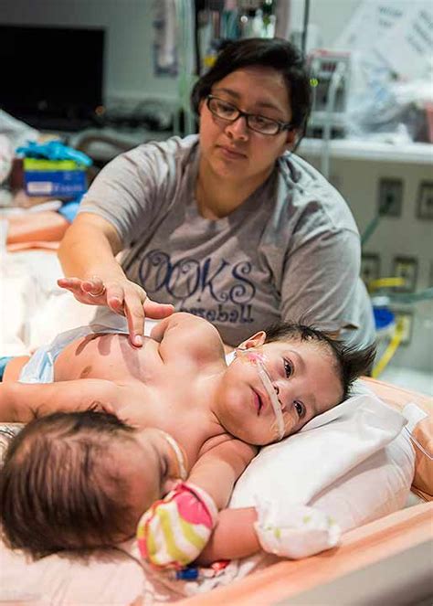 Conjoined Twins Born At Tch
