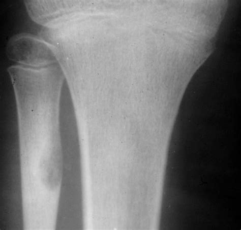Osteoid Osteoma Femur