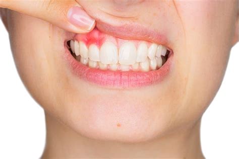 Gingivitis Causes Symptoms Implications And Treatment The Fine Tooth Company