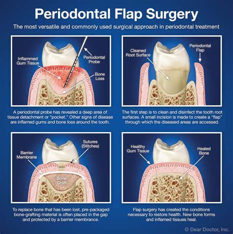 Periodontal Flap Surgery Coastal Periodontics And Implant Dentistry