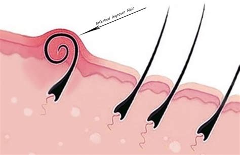 You can get rid of an ingrown hair if it is not too deep in the skin, or you can let the dermatologist do this procedure. Sugar Mama Waxing is Tri-Cities first all body waxing ...