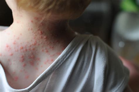 Best Treatments For Common Childhood Rashes