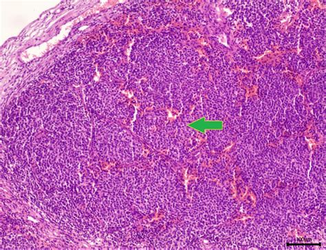 Cureus Merkel Cell Carcinoma An Otolaryngological Point Of View Of