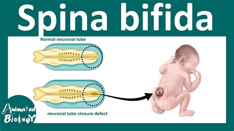 Spina Bifida What Is The Main Cause Of Spina Bifida What Are The Types Of Spina Bifida