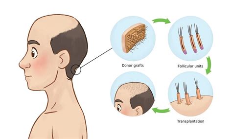 Male Pattern Baldness Faqs And Treatment