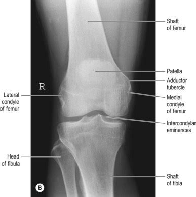 Knee x rays and detecting abnormalities. Knee and femur | Radiology Key