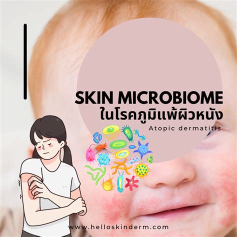 Skin Microbiome ในโรคผื่นภูมิแพ้ผิวหนัง Hello Skin By หมอผิวหนัง