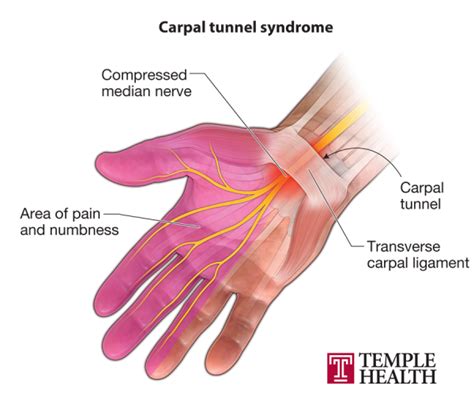 Is Your Wrist Pain Carpal Tunnel Syndrome Temple Health