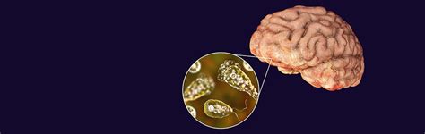 The Genesis Of The “brain Eating” Amoeba Answers In Genesis