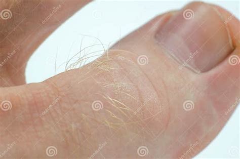 Big Toe Close Up Peeling Skin On Toes Stock Image Image Of