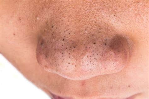 10 Natural Remedies To Get Rid Of Blackheads On The Nose And Causes