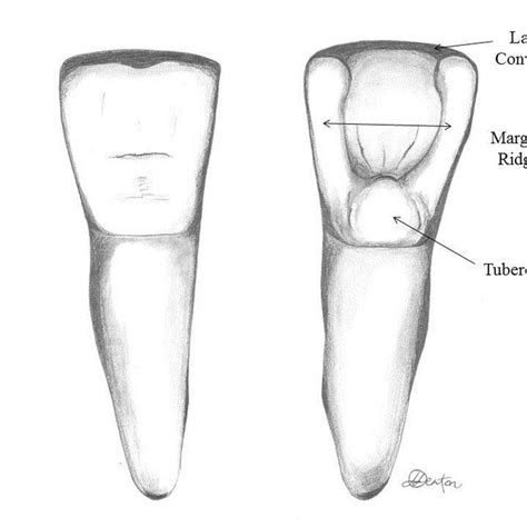 2 Lingual View Of A Non Shovel Shaped Incisor Left And A