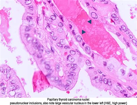 Characteristic orphan annie eye nuclear inclusions (nuclei with uniform staining, which appear empty due to powdery chromatin and marginal micronucleoli)11 and psammoma bodies on light microscopy. Pathology Outlines - Papillary thyroid carcinoma overview