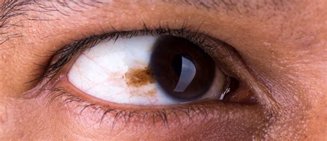 Eye Conditions And Diseases