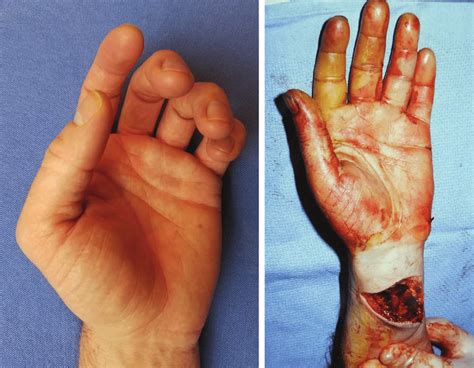 Allows repair of tendons inside tendon sheaths as patients can demonstrate that the inside of the which method of tendon repair will give him the best results in terms of load to failure and gliding. Flexor tendon lacerations cause involved digits to fall ...