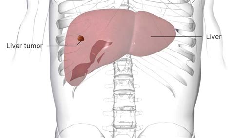 Liver Tumor Treated Non Surgically By Rfa Tace And Tare